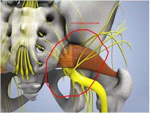你可能需要解决梨状肌损伤!